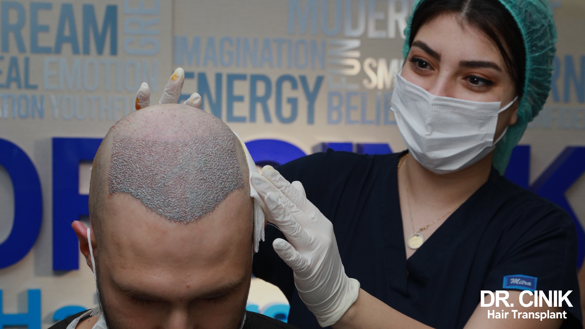 Patient seated in front of the clinic logo wall, the frontal area fully covered with freshly implanted grafts, an assistant holding a compress against the side of the head