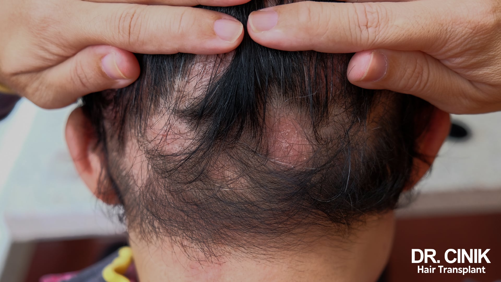 Scalp parted by hand, revealing several round patches of reddened, scaly skin on a young person