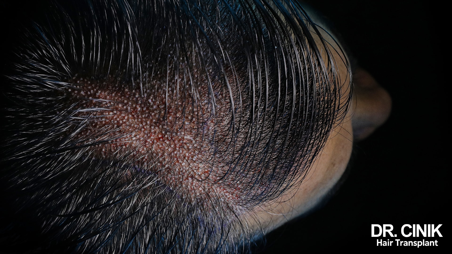 Macro photograph of a scalp showing freshly implanted grafts sitting between existing hairs, with no shaving of the recipient area