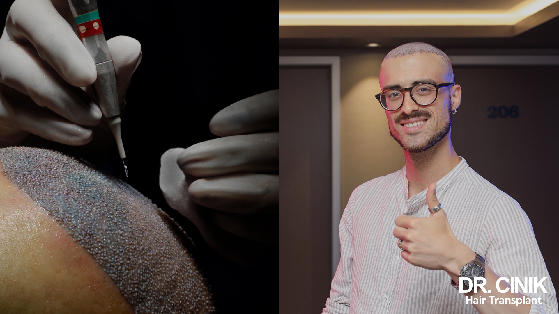 Implanter handled by a gloved practitioner on a densely grafted recipient area, and a smiling patient giving a thumbs up the day after surgery