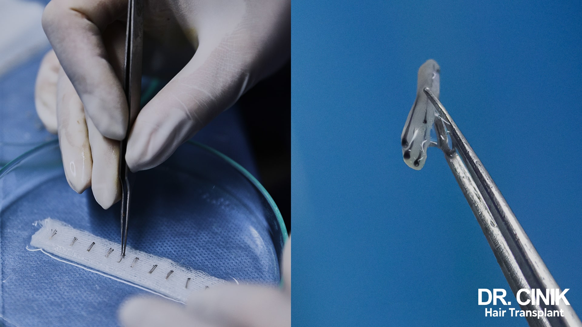Harvested grafts lined up in a culture dish, and a close up of a follicular unit held in forceps