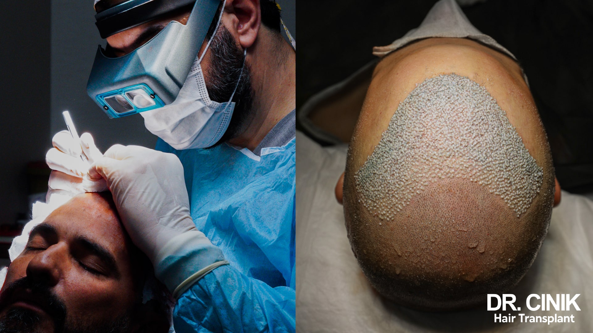 Graft implantation under surgical loupes, and a view of the scalp after extraction showing the recipient area