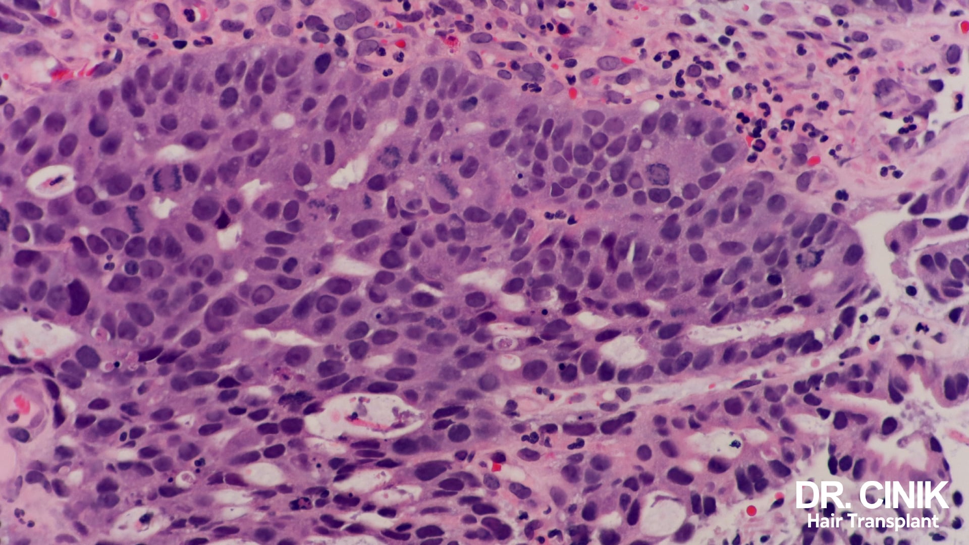 Histological section seen under the microscope, tissue stained purple and pink