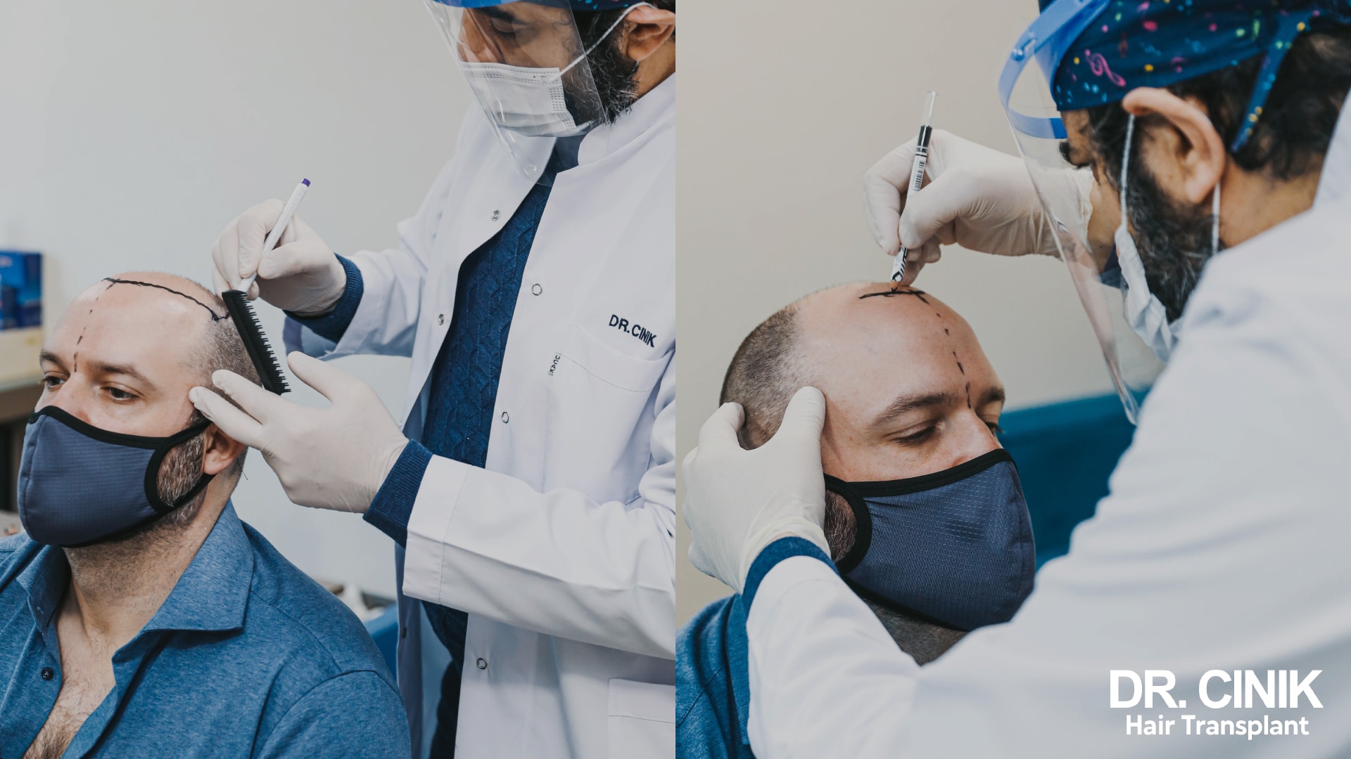Two practitioners drawing the new frontal hairline with a marker on shaved heads, one using a comb, the other a ruler