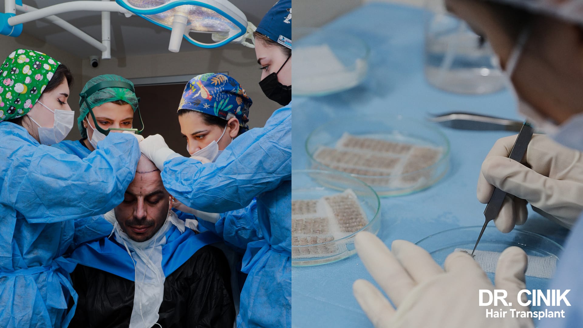 Team of four clinical staff in surgical scrubs around a patient's head, and a close-up of grafts arranged in Petri dishes and handled with forceps