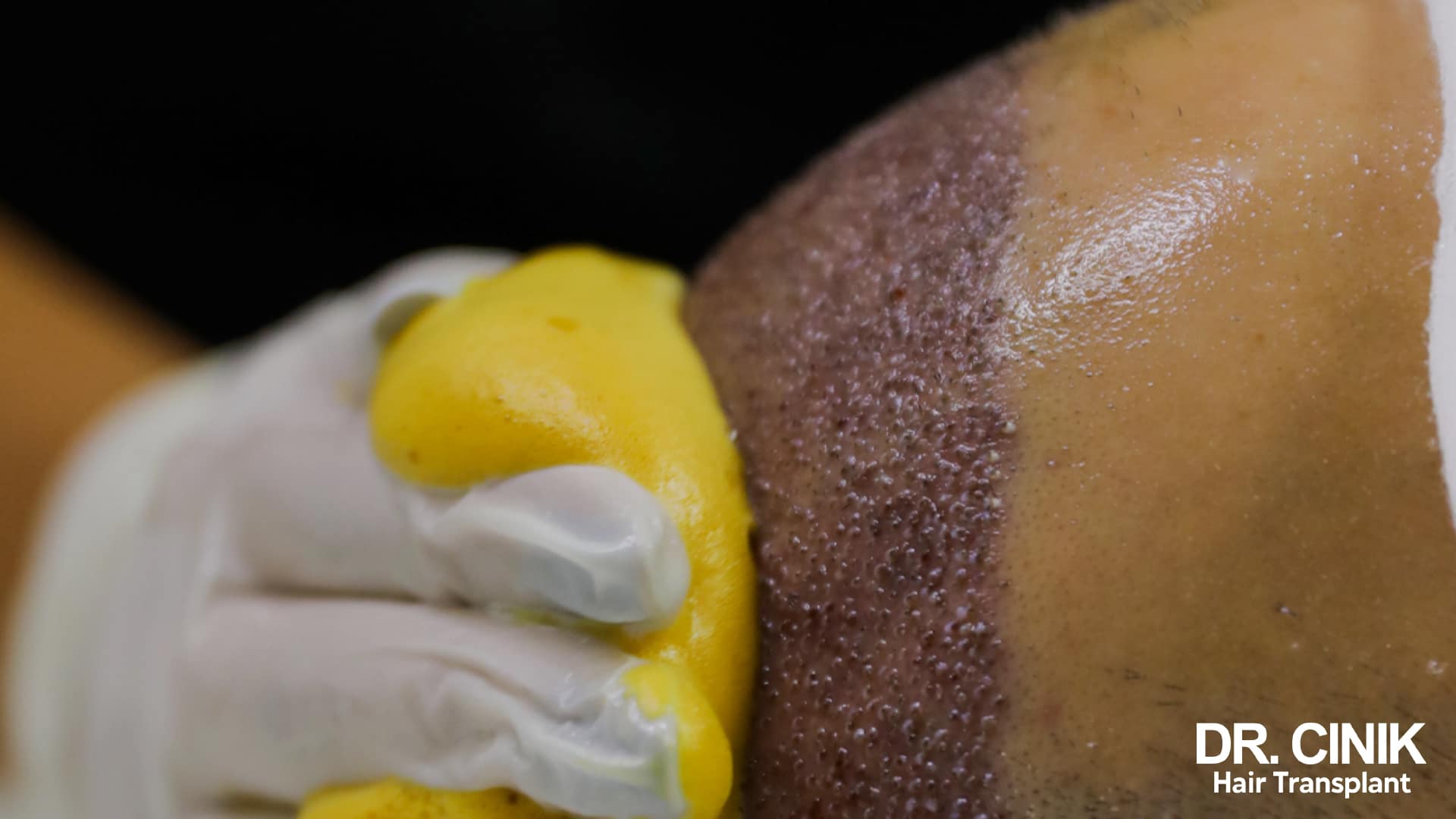 Gloved hand spreading a thick white cream over a freshly grafted scalp where the implanted follicles are visible