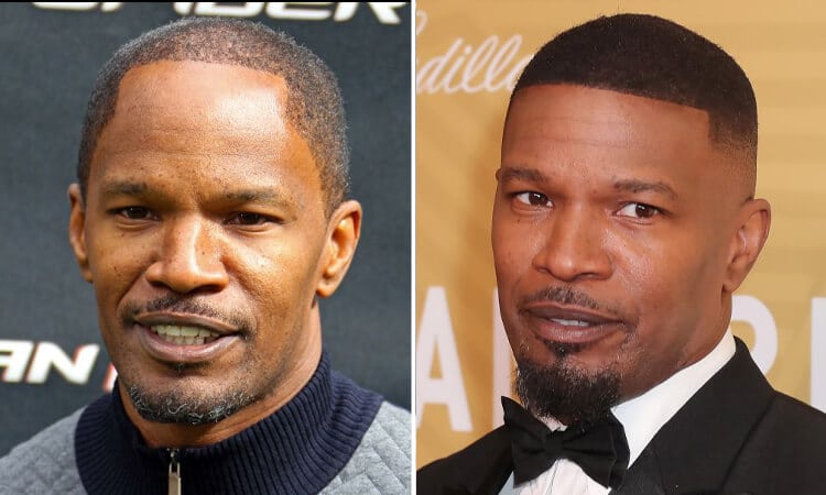 Jamie Foxx Hair Transplant