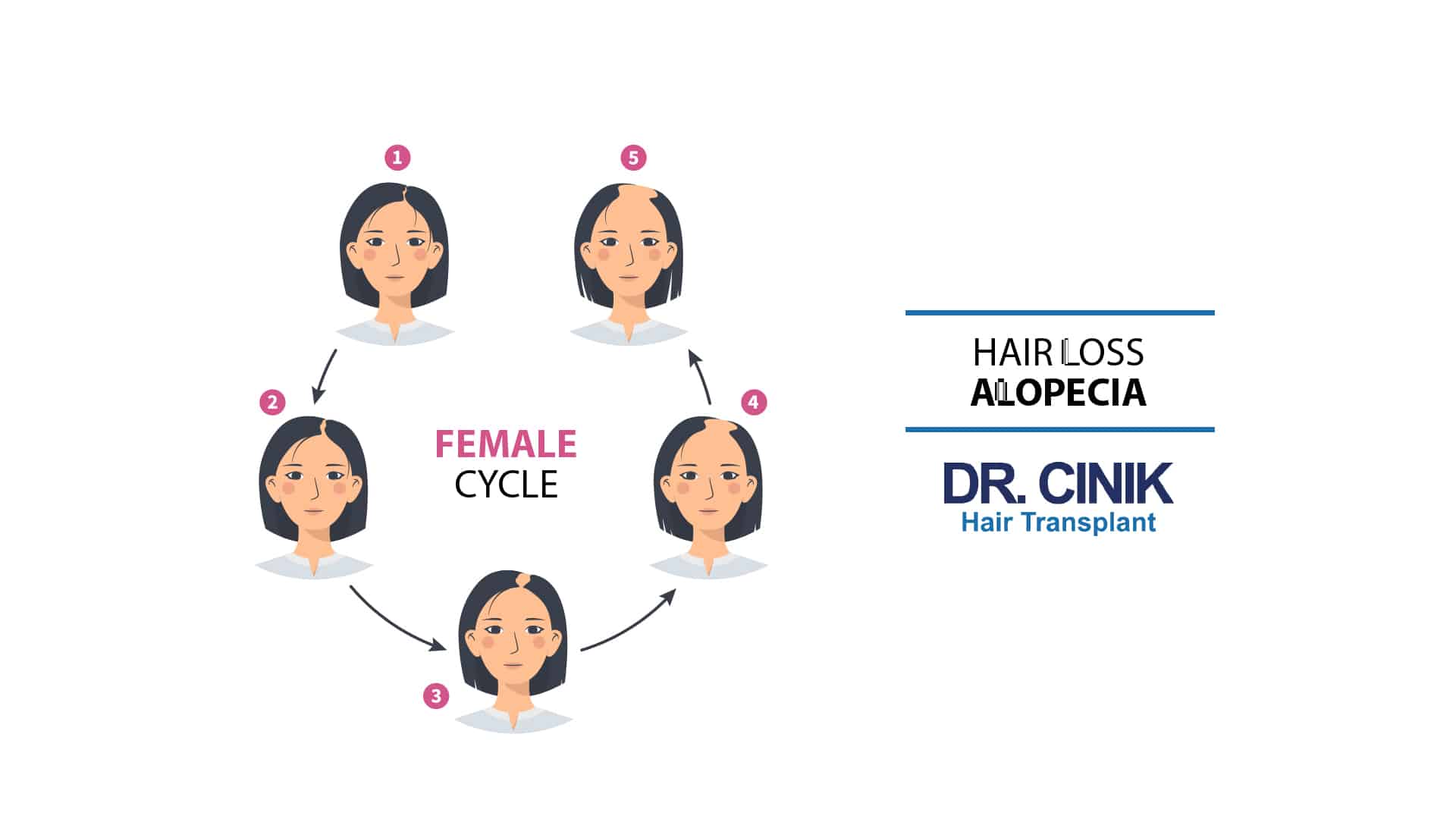 Femal Pattern Baldness Cycle