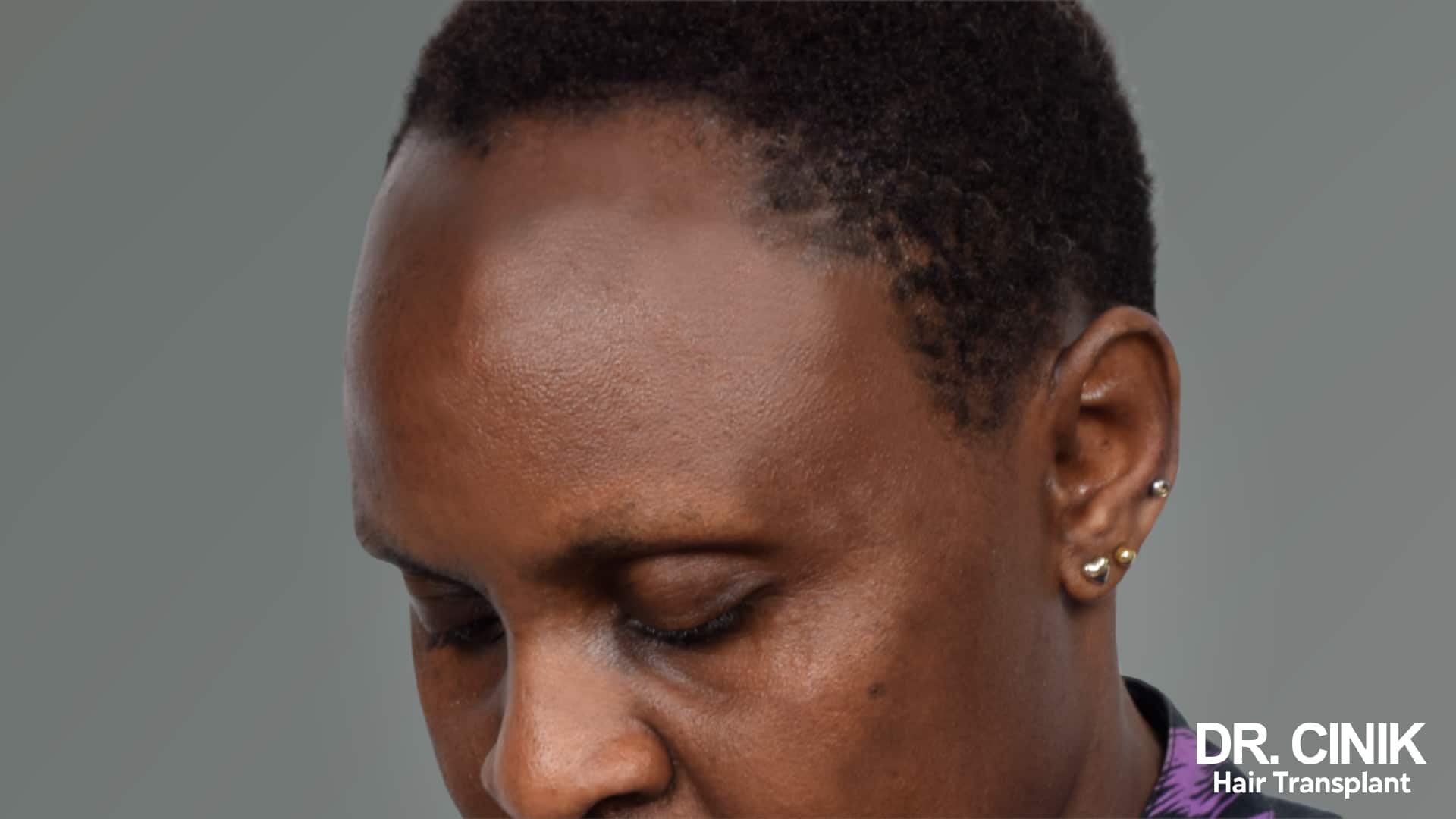Woman with short hair whose front hairline has receded above the temples
