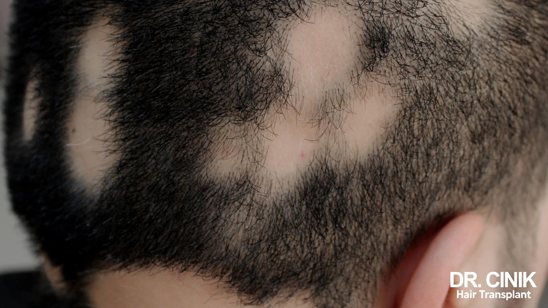 Several round, completely bare patches on a brown-haired scalp
