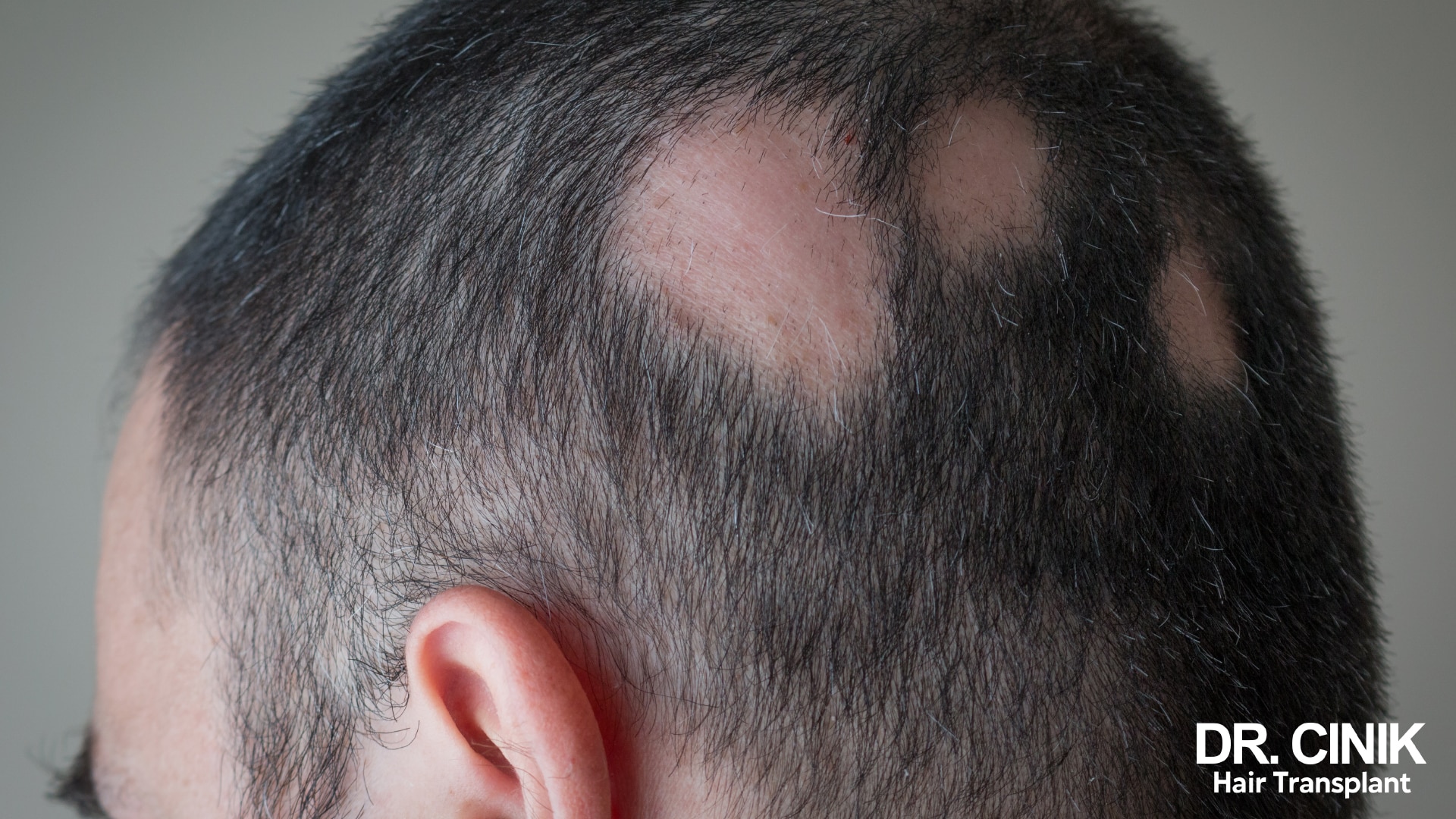 Three-quarter view of a dark-haired man's head, dotted with several round patches of smooth skin where no hair grows any more