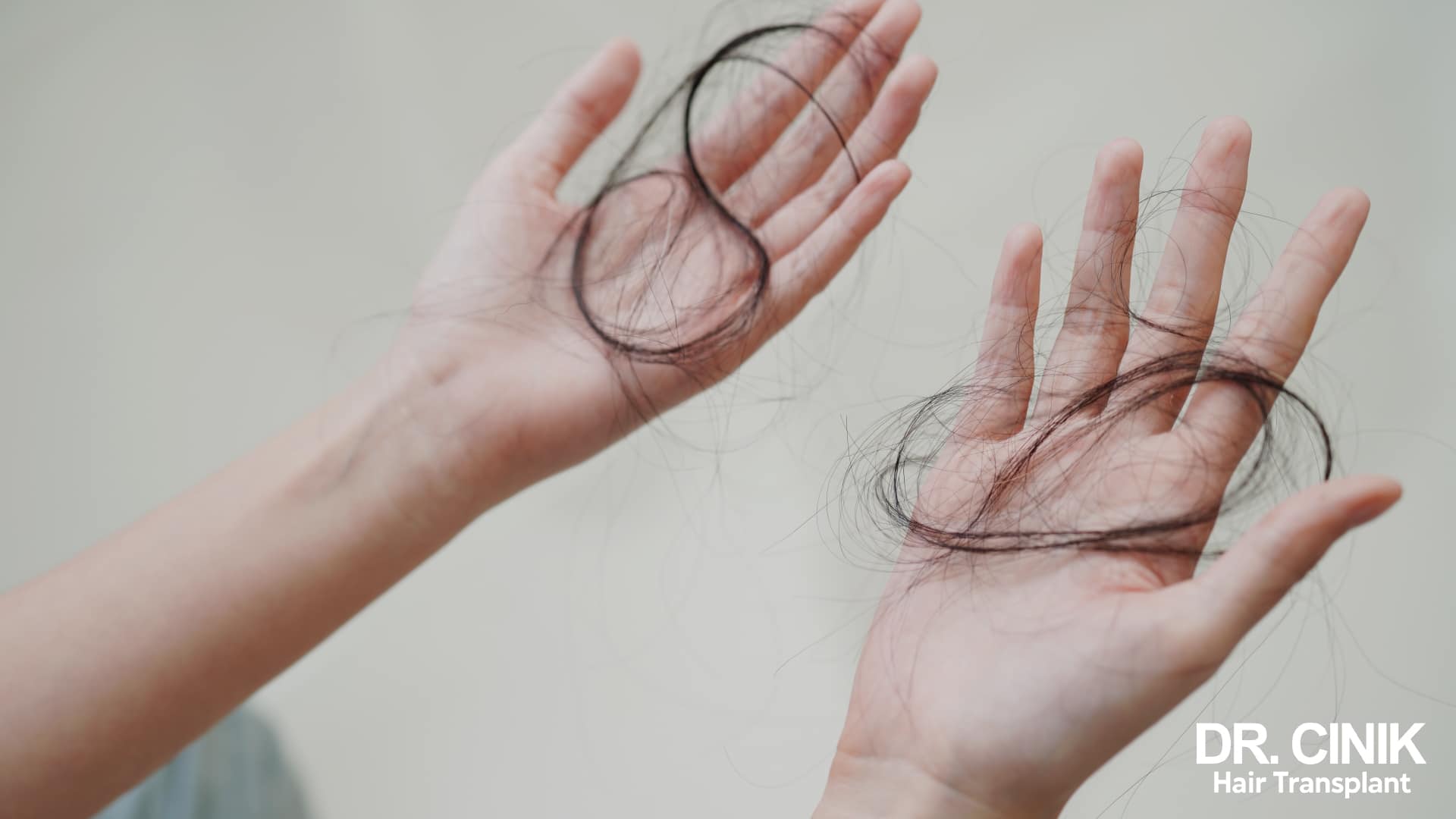 Two open hands covered in long strands of hair shed all at once