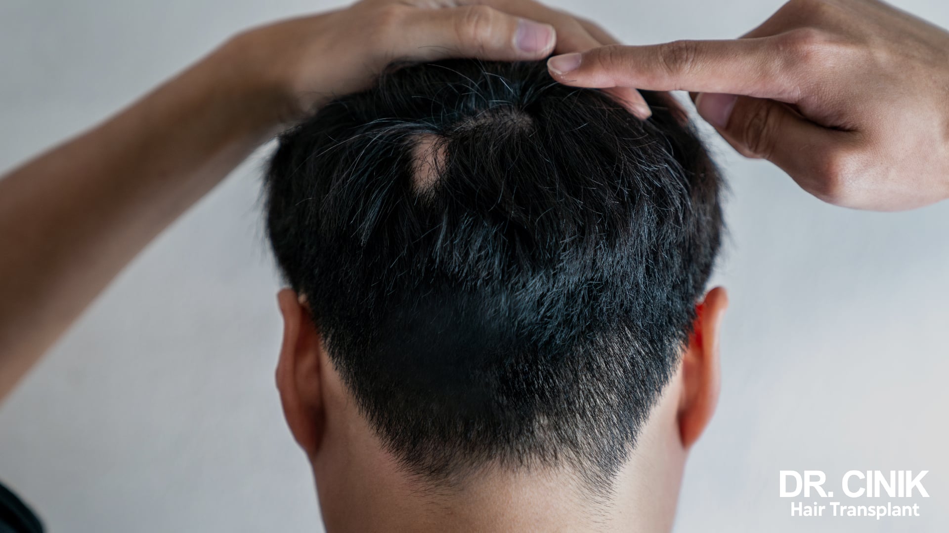 Back of a dark-haired man's head with thick hair, a finger pointing to a single round hairless patch near the crown