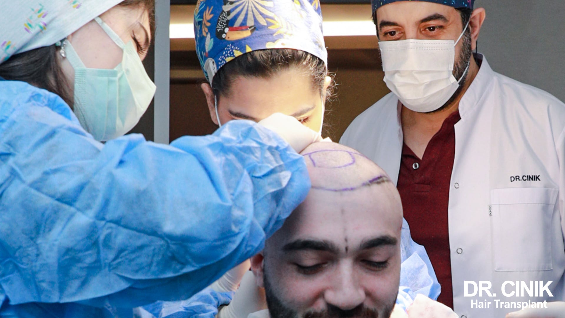 Surgical team with Dr Cinik marking out the graft zones on a patient's shaved scalp before the operation