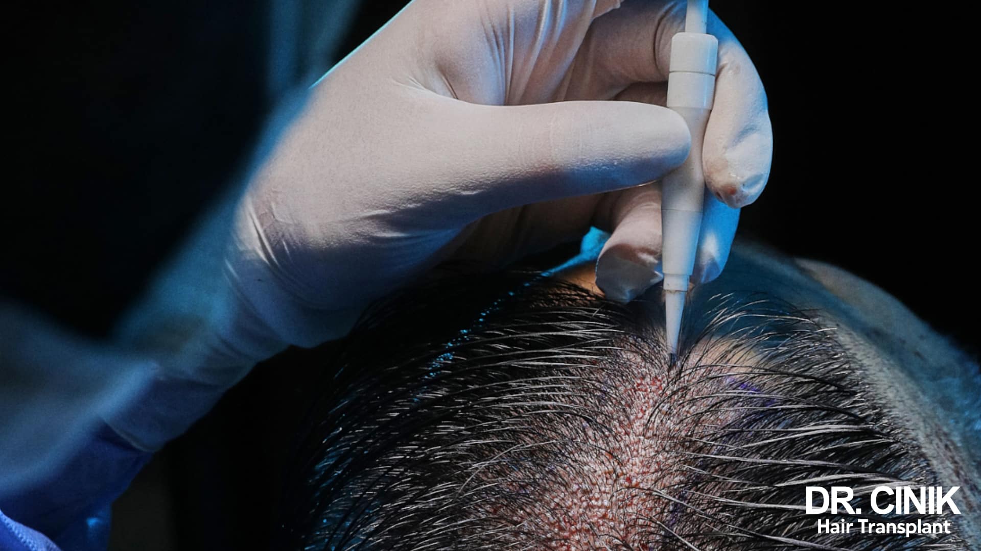 Close-up of a gloved hand inserting a graft into the scalp using an implanter pen