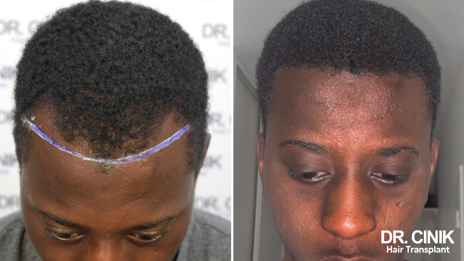 Before and after photographs of a patient with afro hair, the frontal line marked out on the left, restored density at the front on the right