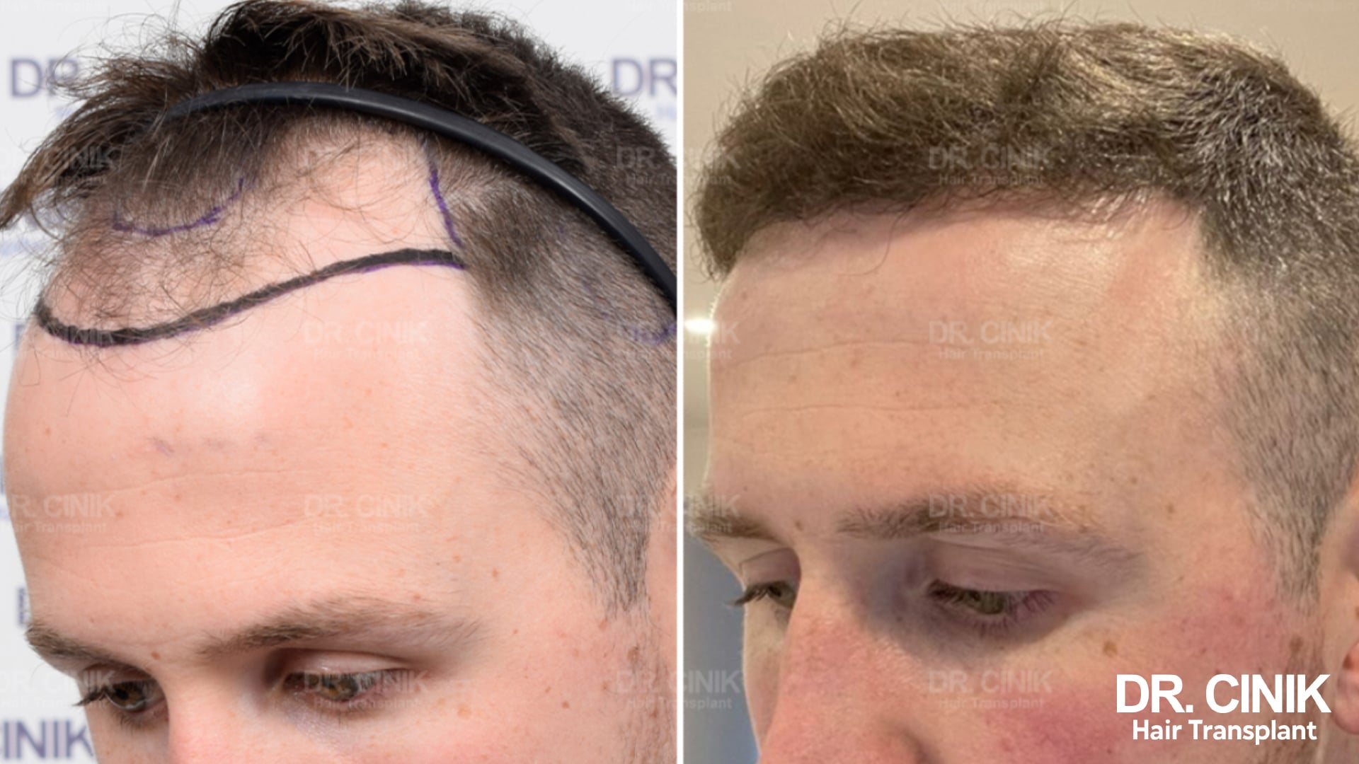 Before and after photographs of a young patient, the planned frontal line drawn in on the left, a restored hairline on the right