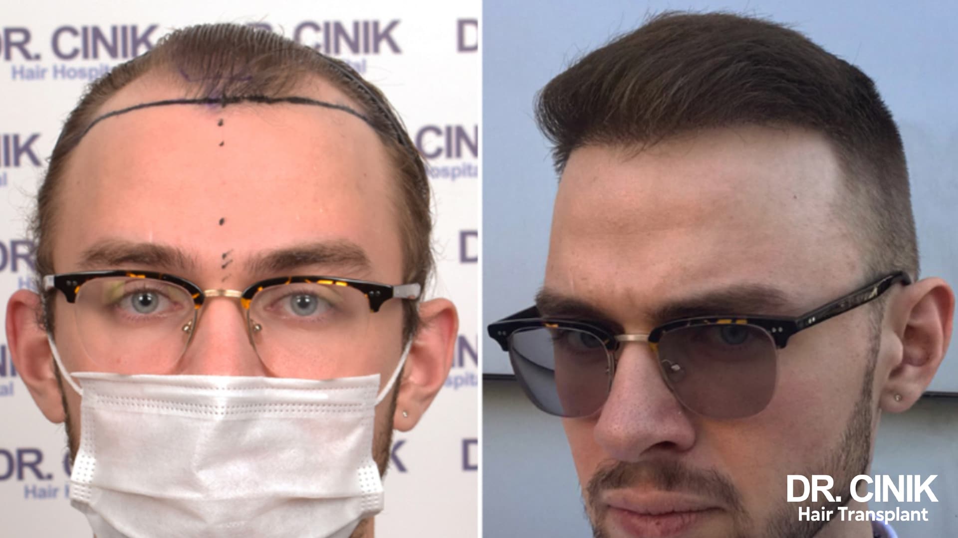 Before and after photographs of a patient with glasses, a high thinning hairline on the left, a rebuilt frontal line on the right
