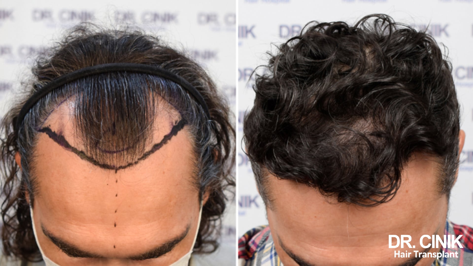 Before and after photographs of a patient with curly hair, the frontal zone outlined on the left, dense curly hair at the front on the right