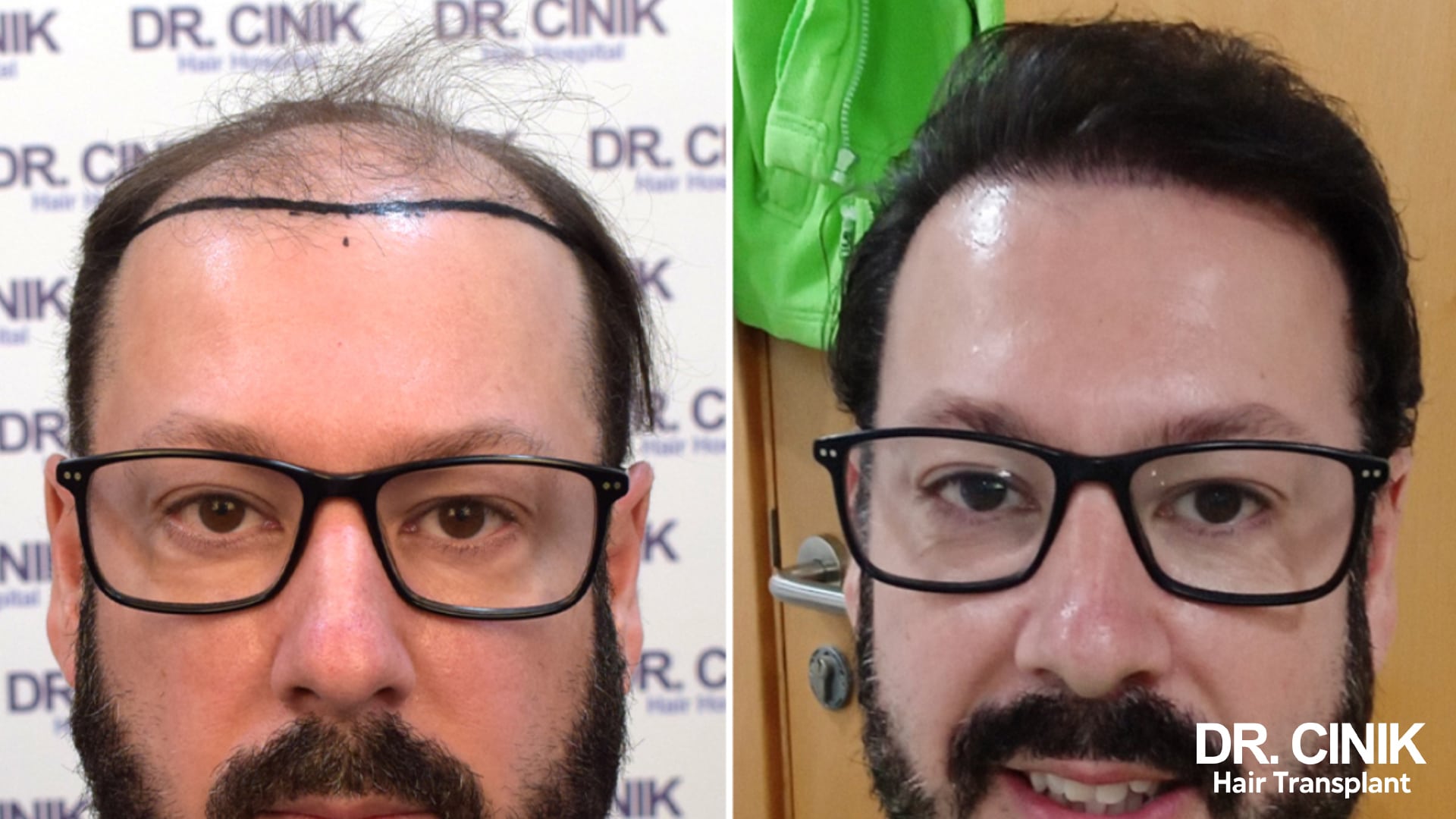 Before and after photographs of a patient with a marked frontal recession on the left and a rebuilt hairline framing the face on the right