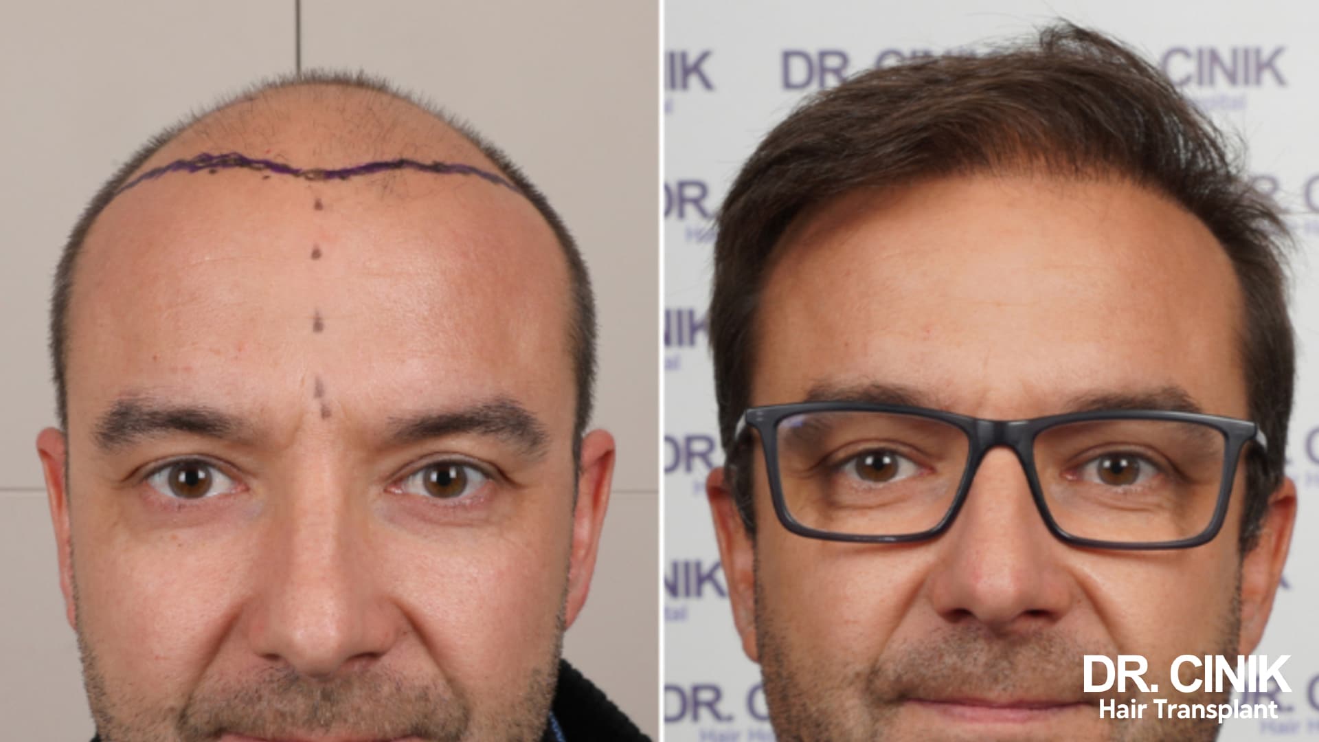 Before and after photographs of a patient with an advanced recession and the design line drawn on the left, a full frontal area on the right