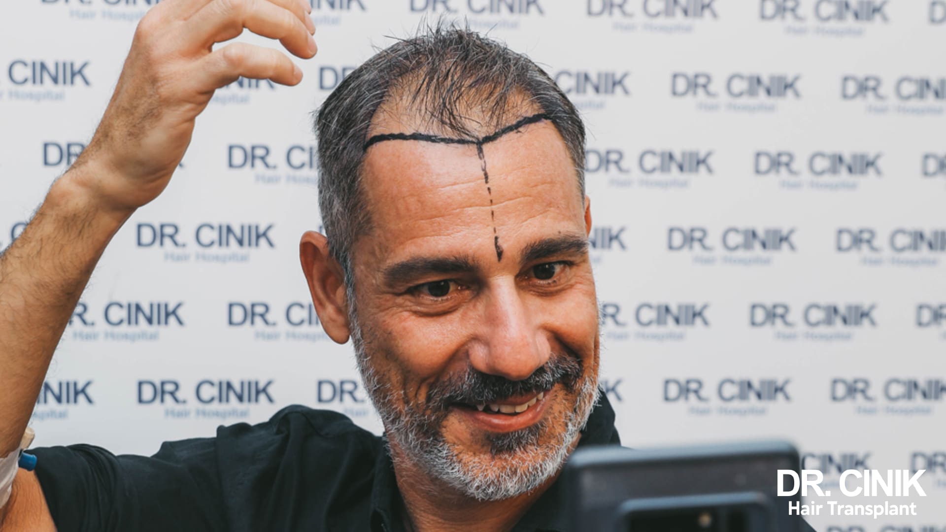Smiling patient whose future frontal hairline has been drawn with a marker, standing in front of a wall of clinic logos