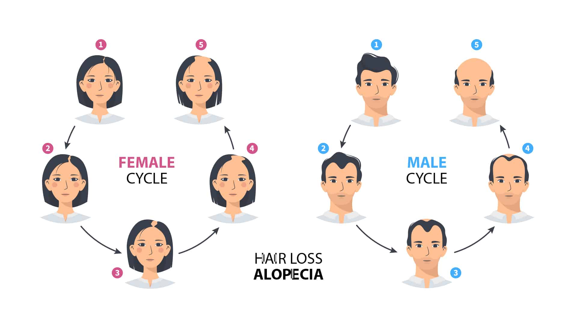 Infographic labelled hair loss alopecia, comparing a female cycle and a male cycle in five numbered stages each: on the left the woman's parting widens and the top of the head thins while the frontal line stays, on the right the man recedes from the temples through to complete baldness