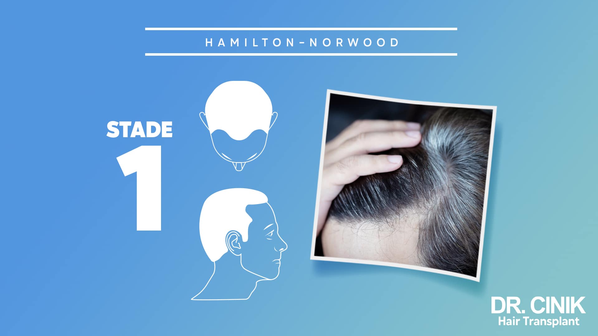 Planche Hamilton-Norwood du stade 1, silhouettes de dessus et de profil sans zone dégarnie, avec la photo d'un cuir chevelu dont la ligne frontale est intacte