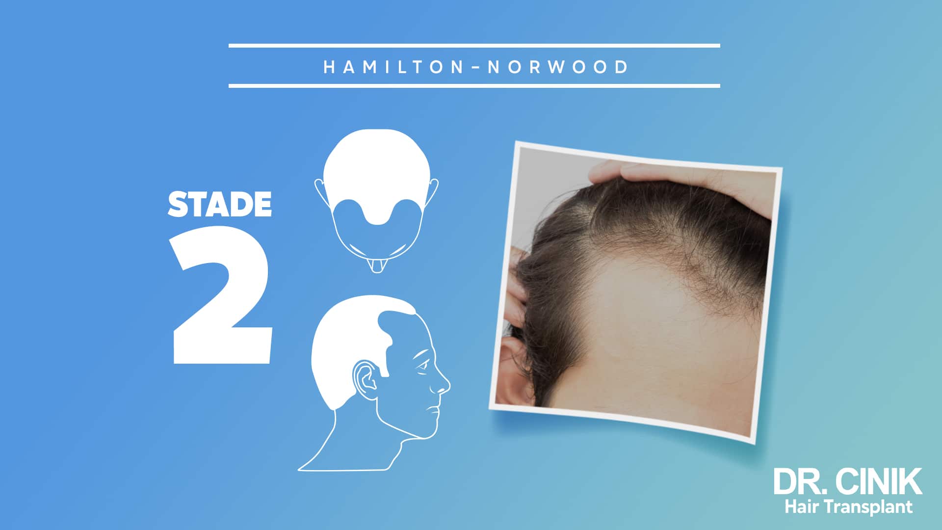 Planche Hamilton-Norwood du stade 2, silhouettes montrant un recul modeste et symétrique des golfes, avec la photo d'une tempe dégagée sur un front encore garni