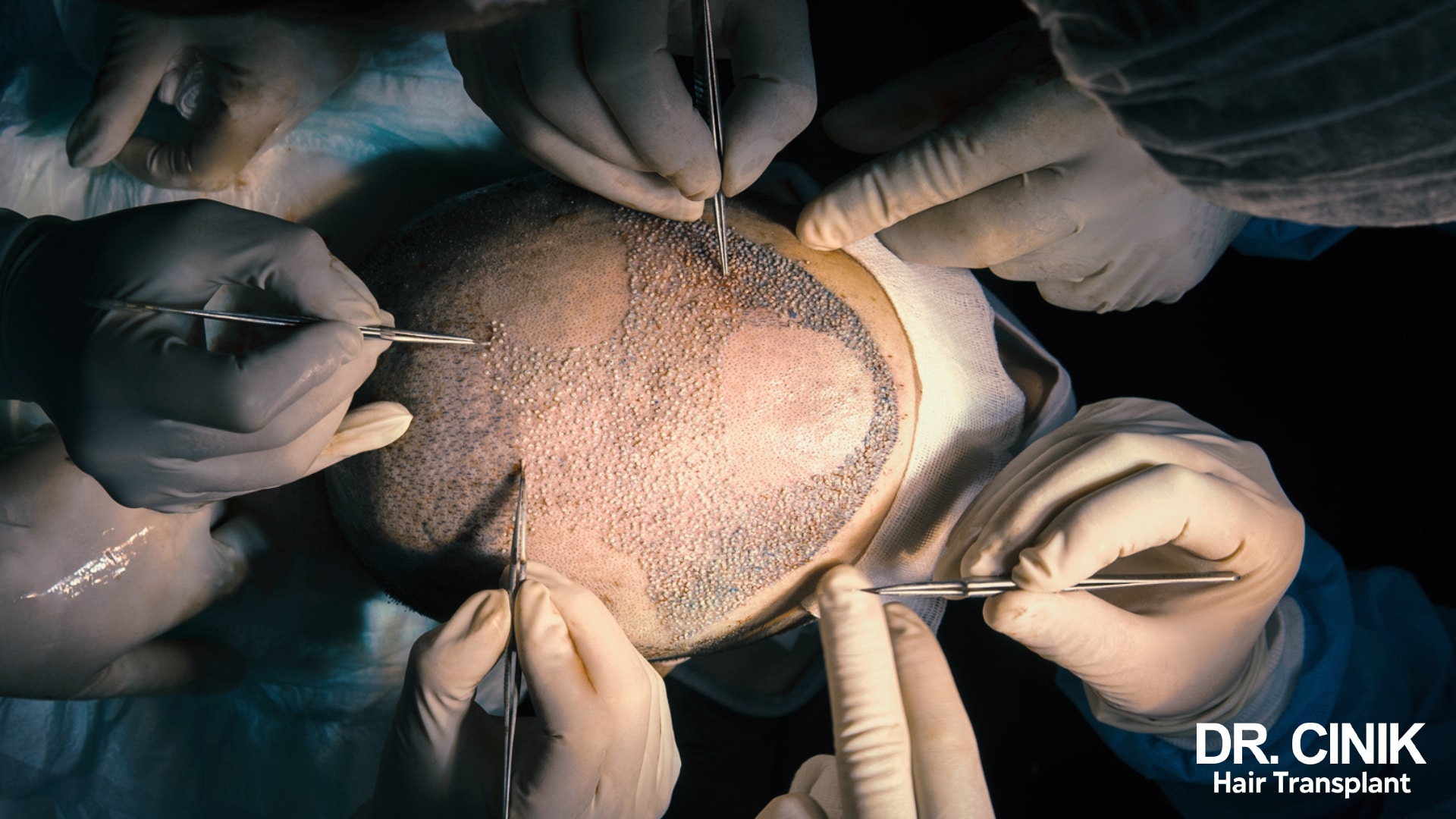 Top view of a shaved scalp during implantation, several gloved hands placing grafts with forceps