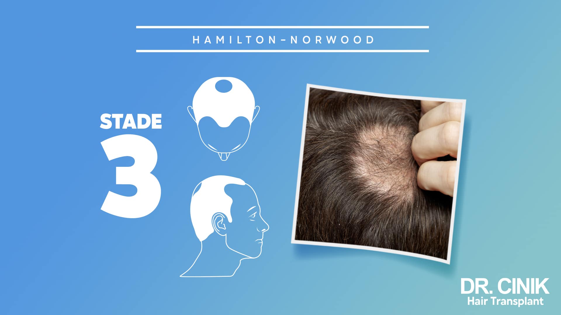 Hamilton-Norwood plate for stage 3, top and profile diagrams next to a photograph of a thinning crown
