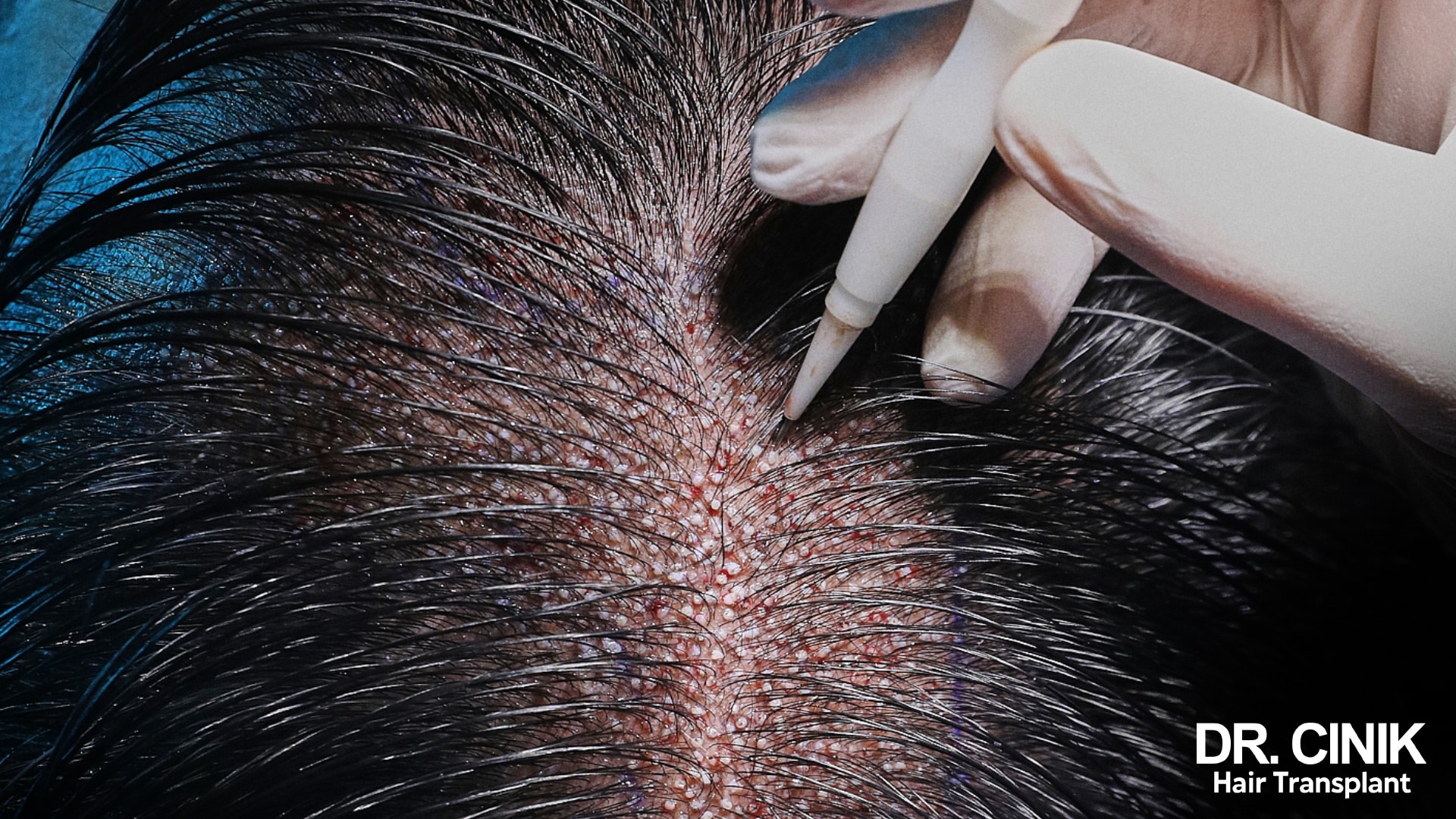 Close-up of a DHI implanter pen held in a gloved hand among freshly implanted hairs