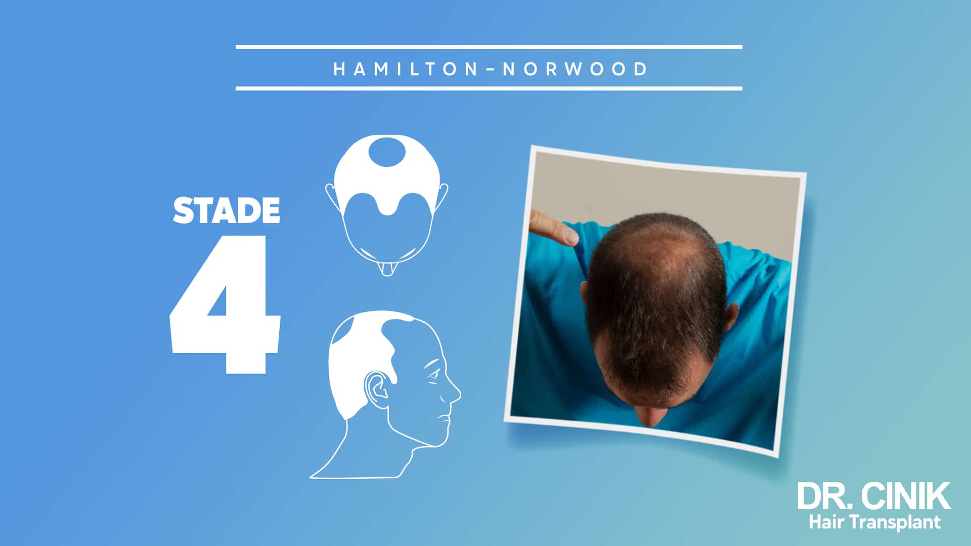 Planche Hamilton-Norwood du stade 4, silhouettes où la zone du sommet reste séparée du front par une bande de cheveux, avec la photo d'un crâne penché en avant