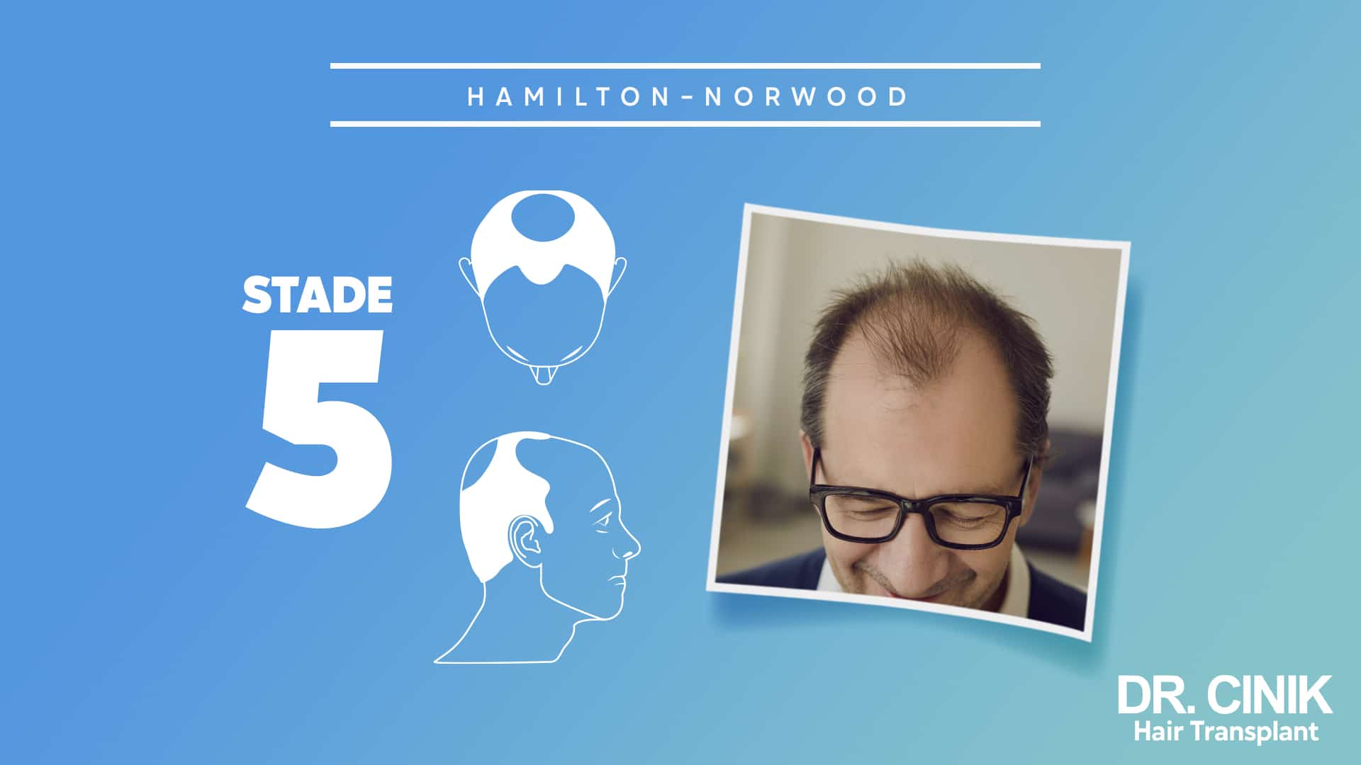 Planche Hamilton-Norwood du stade 5, silhouettes où la bande centrale s'est amincie entre les deux zones dégarnies, avec le portrait d'un homme à lunettes au front largement dégagé