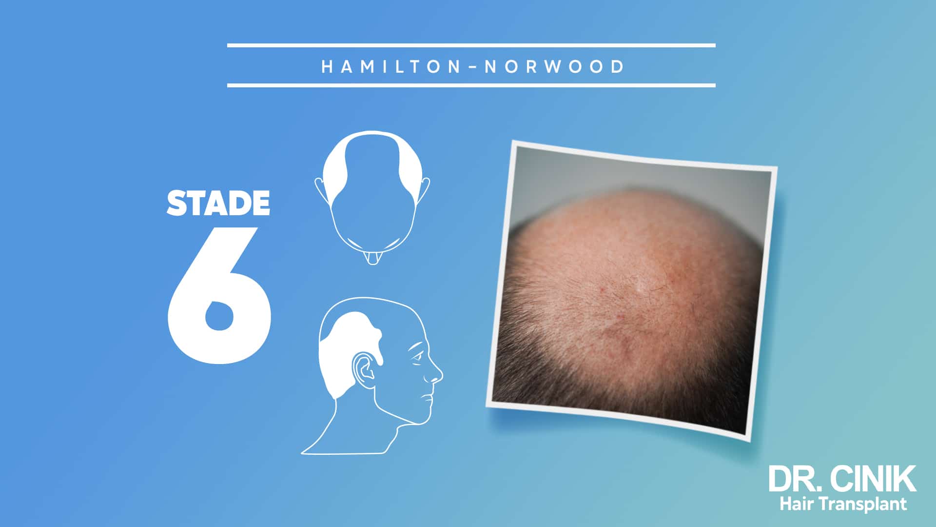 Planche Hamilton-Norwood du stade 6, silhouettes où le front et le sommet ne forment plus qu'une seule surface, avec la photo rapprochée d'un dessus de crâne dégarni
