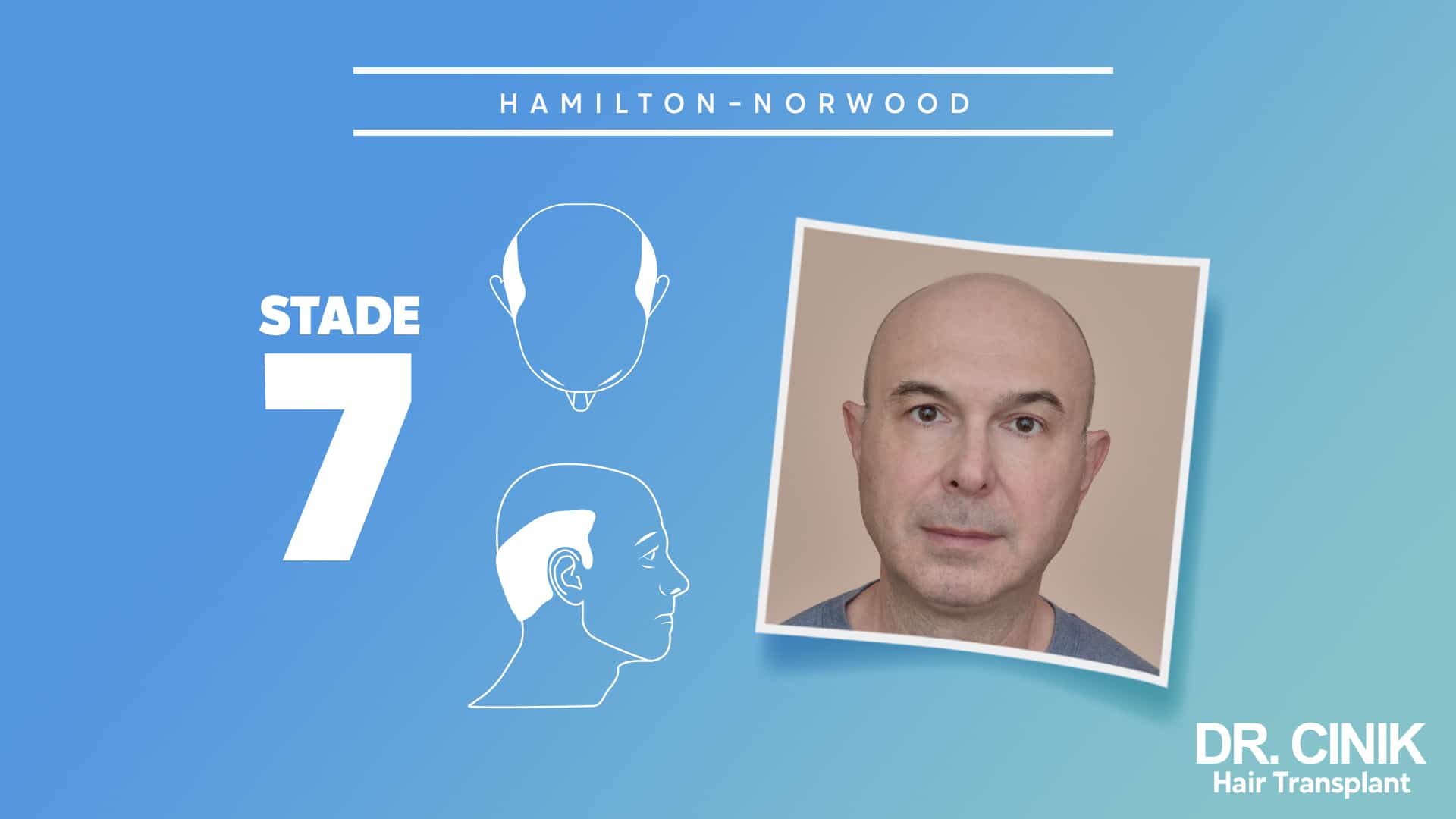 Planche Hamilton-Norwood du stade 7, silhouettes ne conservant qu'une couronne étroite sur les côtés et l'arrière, avec le portrait de face d'un homme au crâne entièrement dégarni