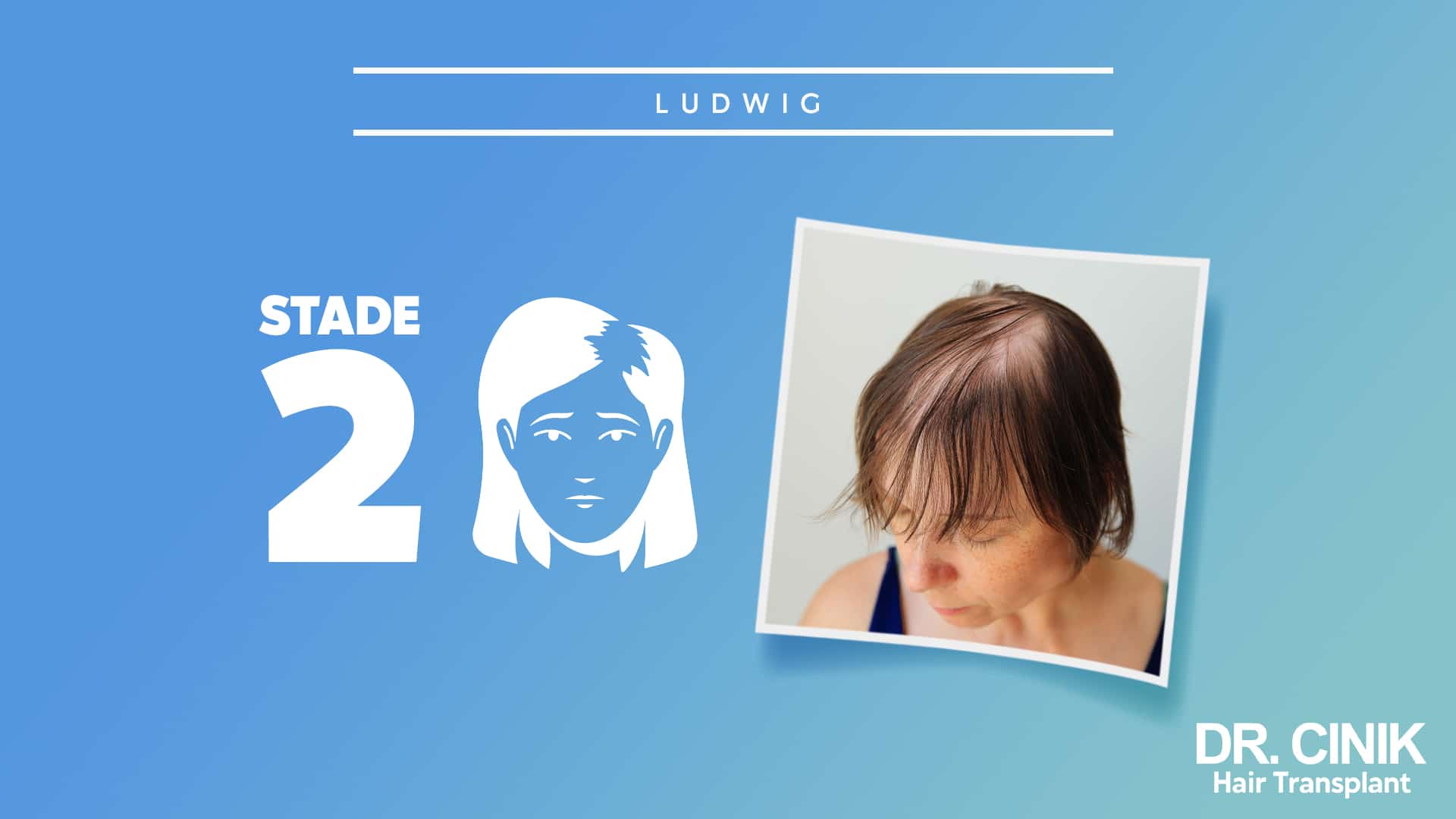 Ludwig plate for stage 2, illustration of a woman's face beside a photograph of a widened parting on the top of the head