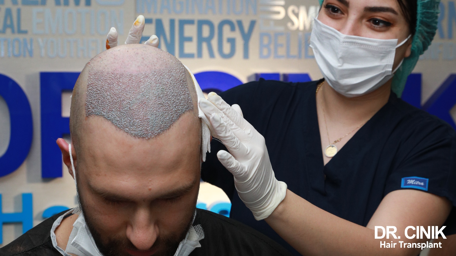 Top of a patient's head at the end of surgery: the whole thinned frontal area is covered with freshly implanted grafts, being dabbed by a gloved nurse