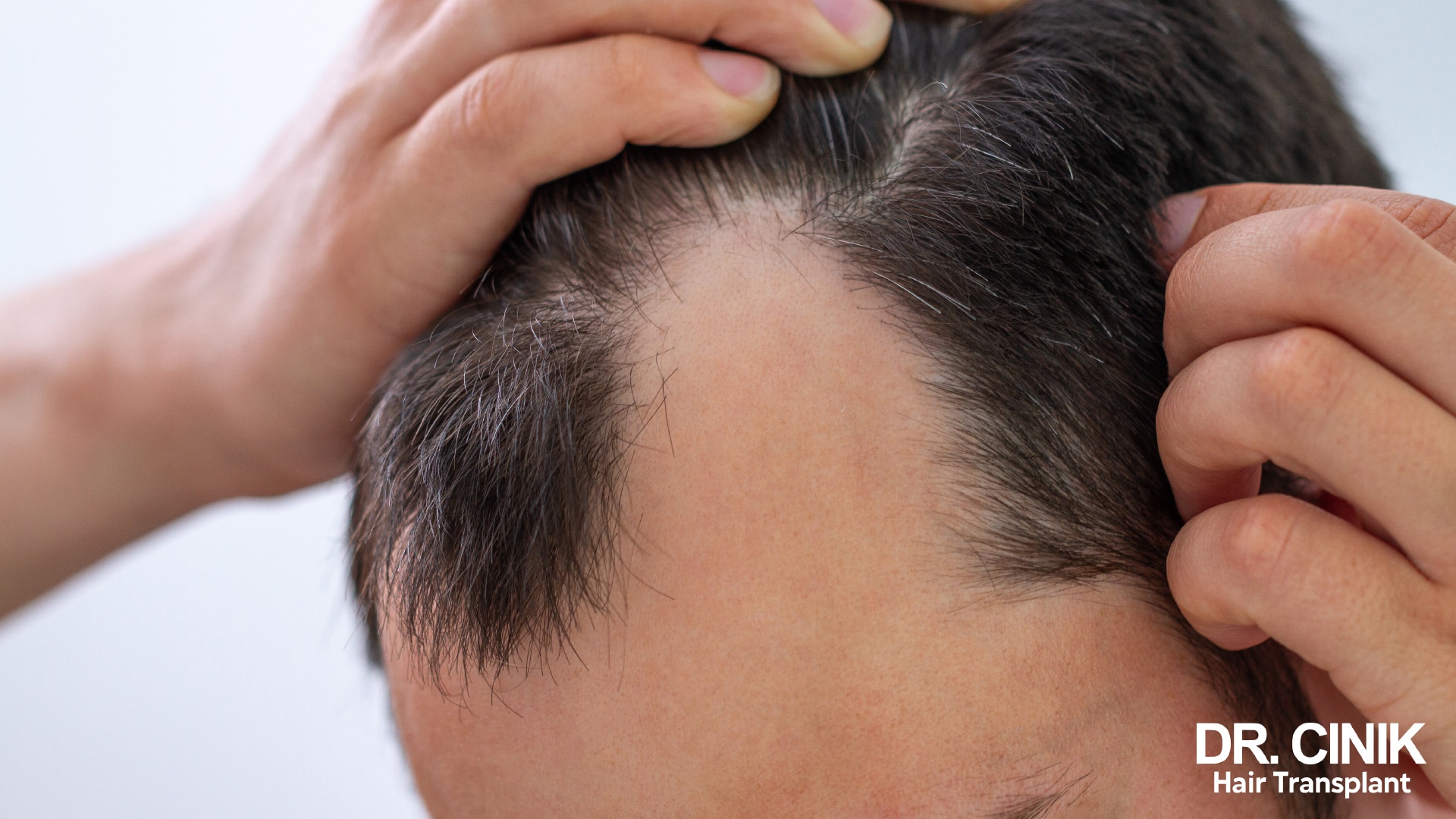 Close-up of a man's scalp, hair parted by hand, receding temple and visible skin