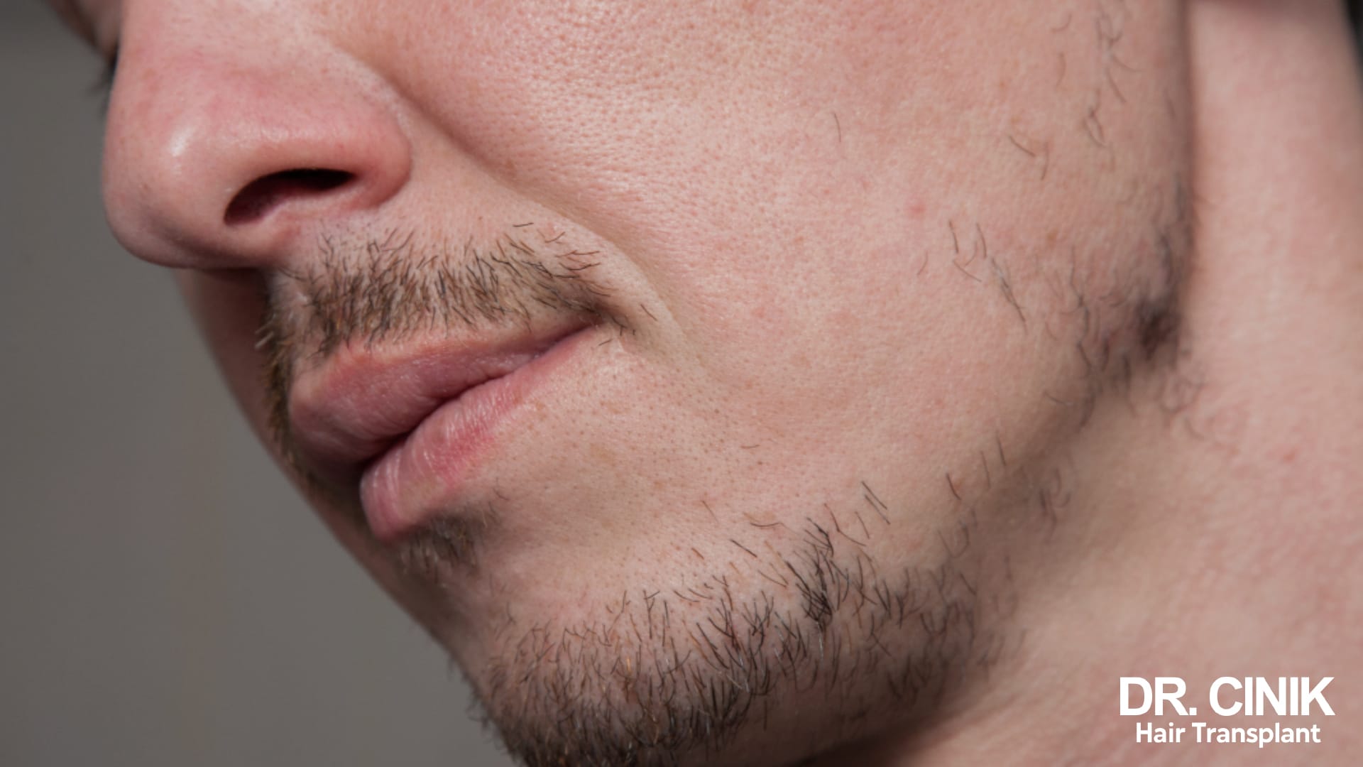 Profil rapproché d'un homme dont la joue est presque glabre alors que la moustache et le menton portent quelques poils épars