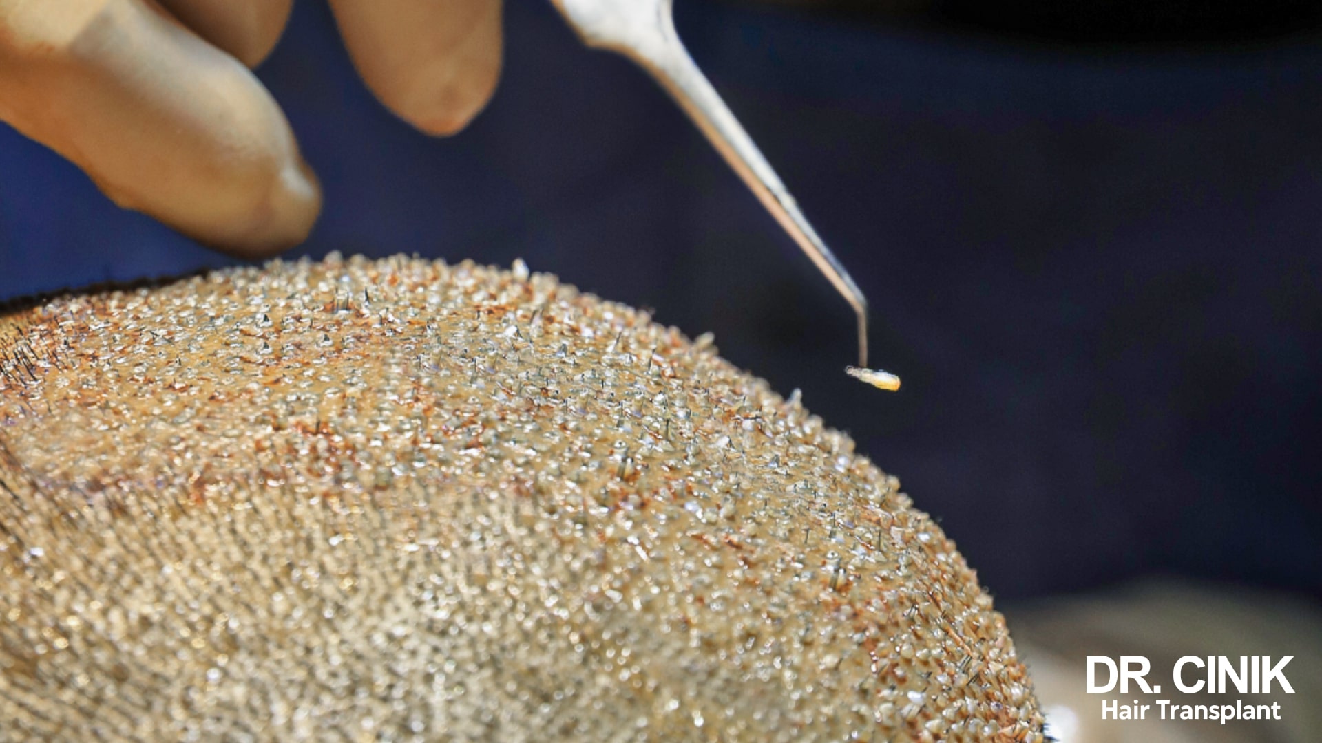 Microscope close-up of a strip of scalp being dissected, with forceps holding a single follicular unit above the harvested tissue