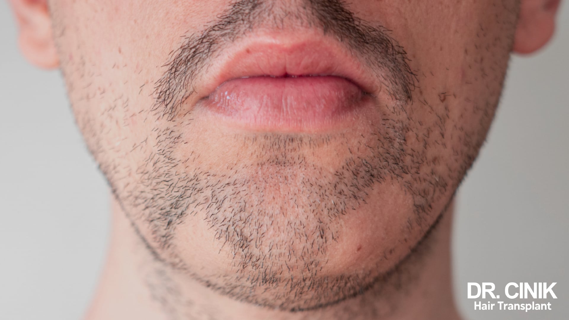 Vue de face d'une barbe clairsemée, la peau restant visible entre les poils sur les joues et sous la lèvre inférieure