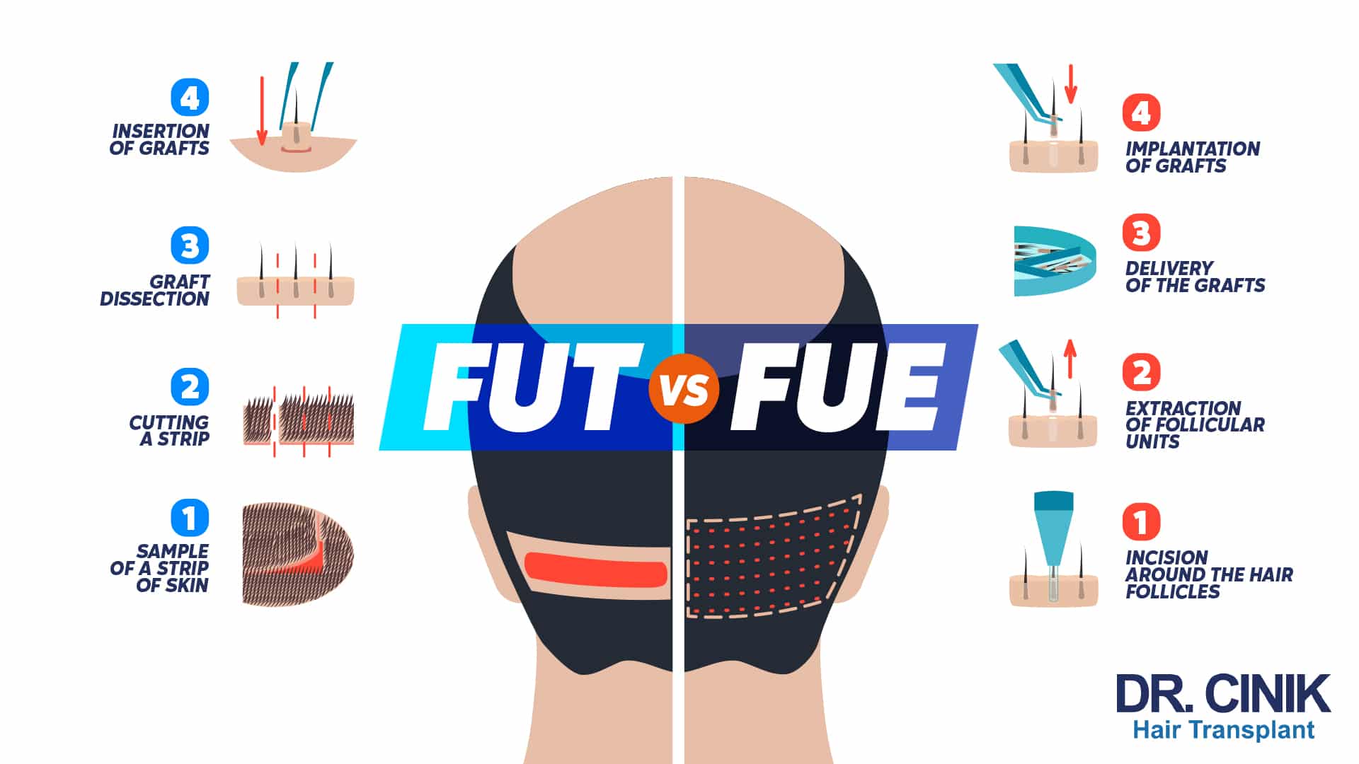 Infographic comparing the four FUT stages, from sample of a strip of skin, cutting a strip and graft dissection to insertion of grafts, with the four FUE stages, from incision around the hair follicles and extraction of follicular units to delivery and implantation of grafts