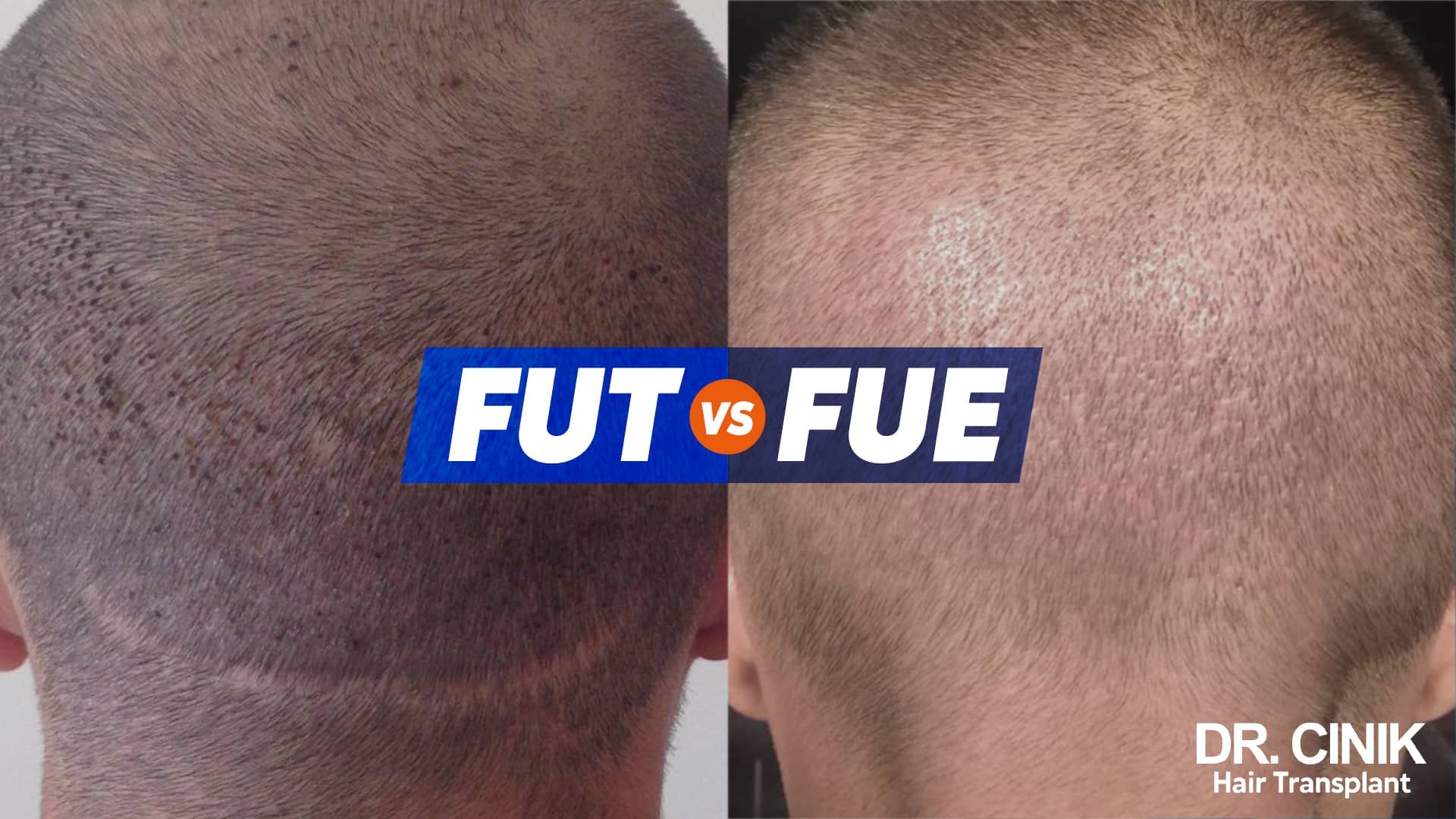 Two clipped napes side by side, a continuous horizontal scar line on the left and scattered extraction dots on the right