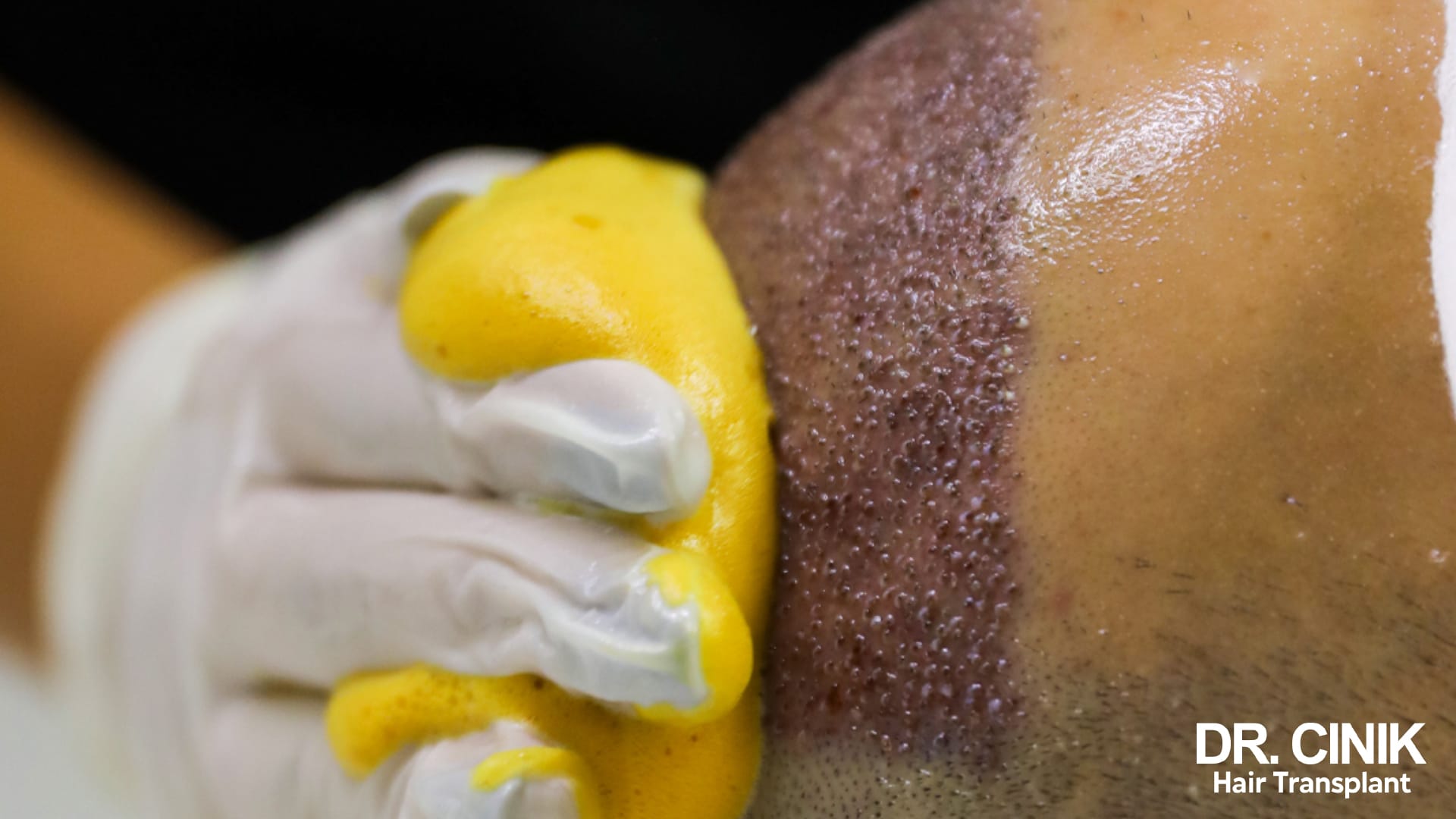 Close-up of a grafted area, red and dotted with small crusts, being cleaned with foam and a sponge