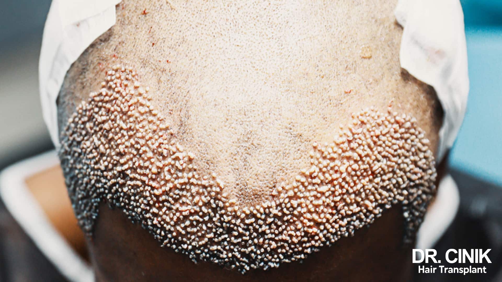Close-up of a clipped scalp after surgery, with a band of small pale crusts marking the border between the operated area and the remaining hair