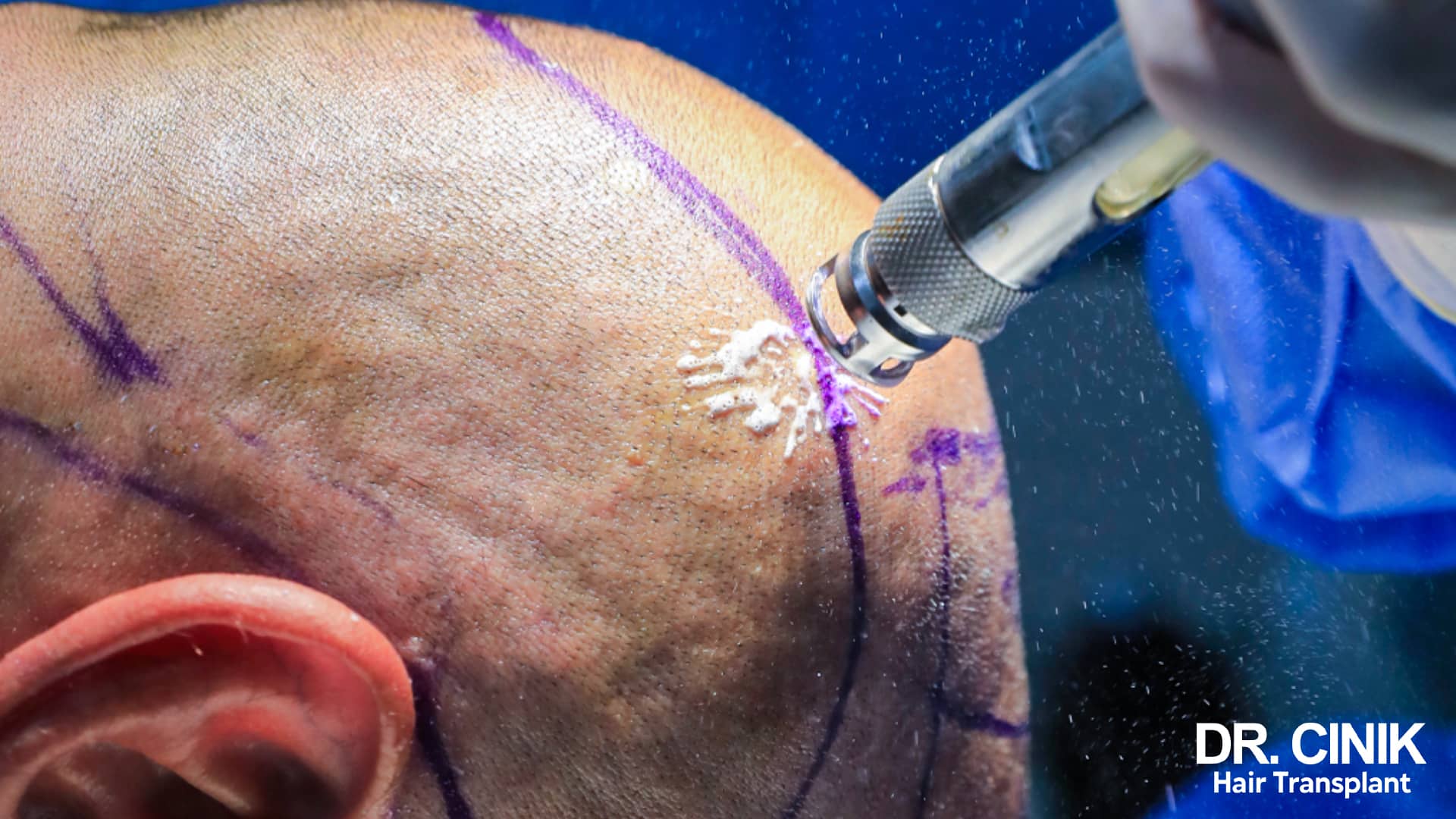 Shaved scalp marked out in purple to delimit the harvesting zones, with an extraction handpiece resting against the skin