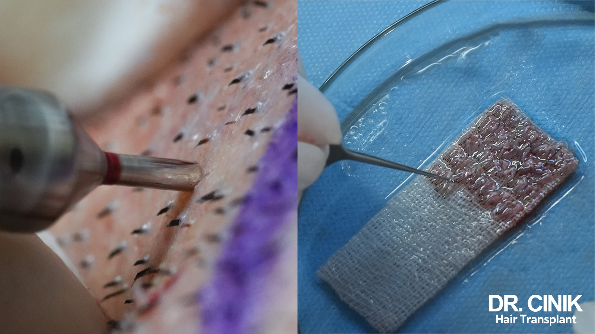 Split view of a motorised punch extracting a follicle from a scalp marked out in pen, and a tray of grafts lined up on a damp gauze