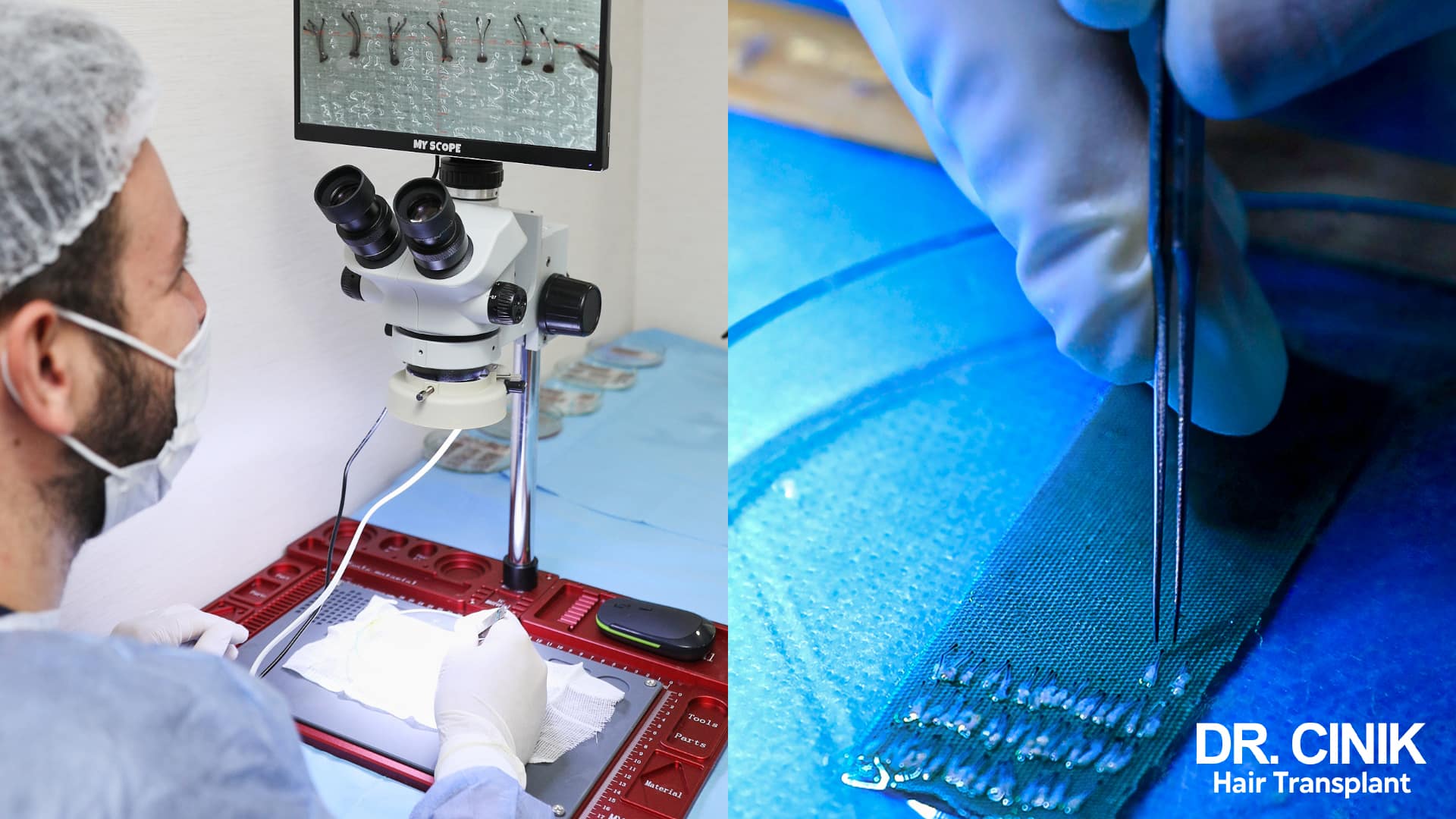 Grafts being counted under a microscope, follicular units displayed on the screen, and grafts lined up on a sterile drape