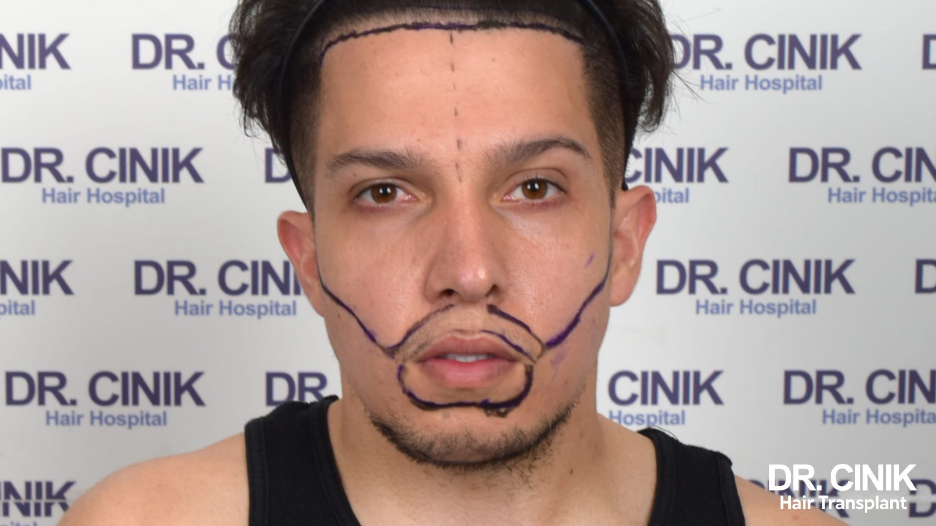 Patient de face avant l'intervention, contours de la barbe et de la ligne frontale dessinés au marqueur violet